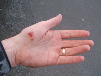 gory injured hand